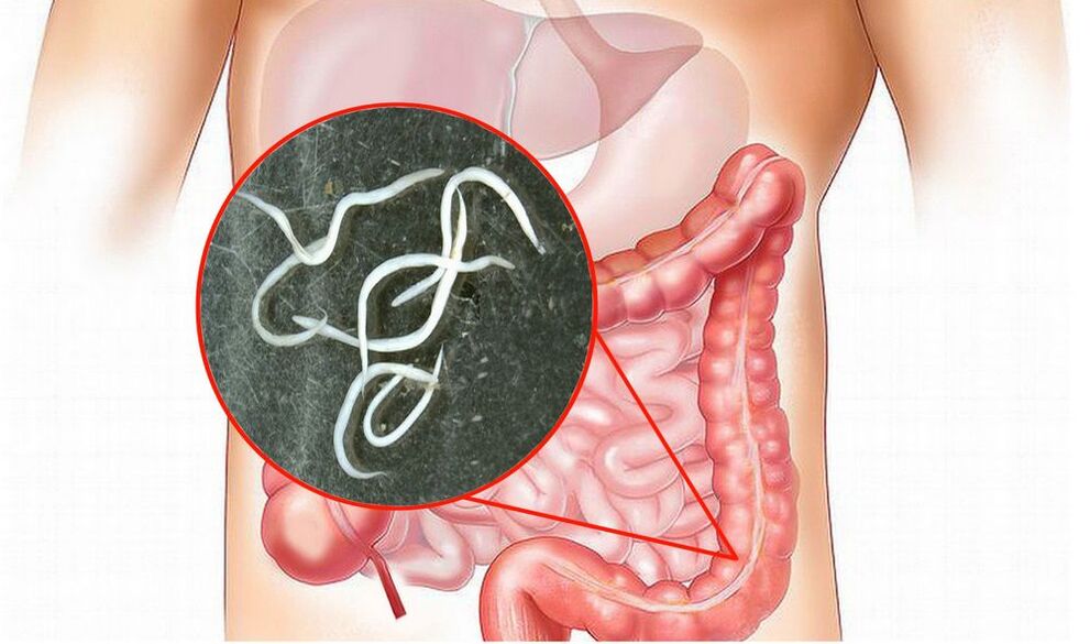 Parasiten im menschlichen Körper ohne Behandlung